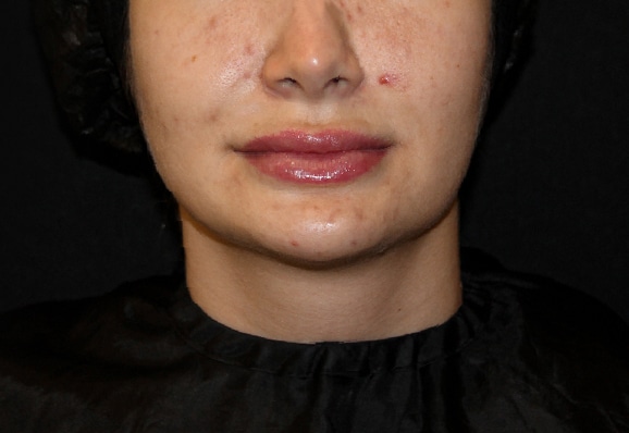 before-acne-renophase
