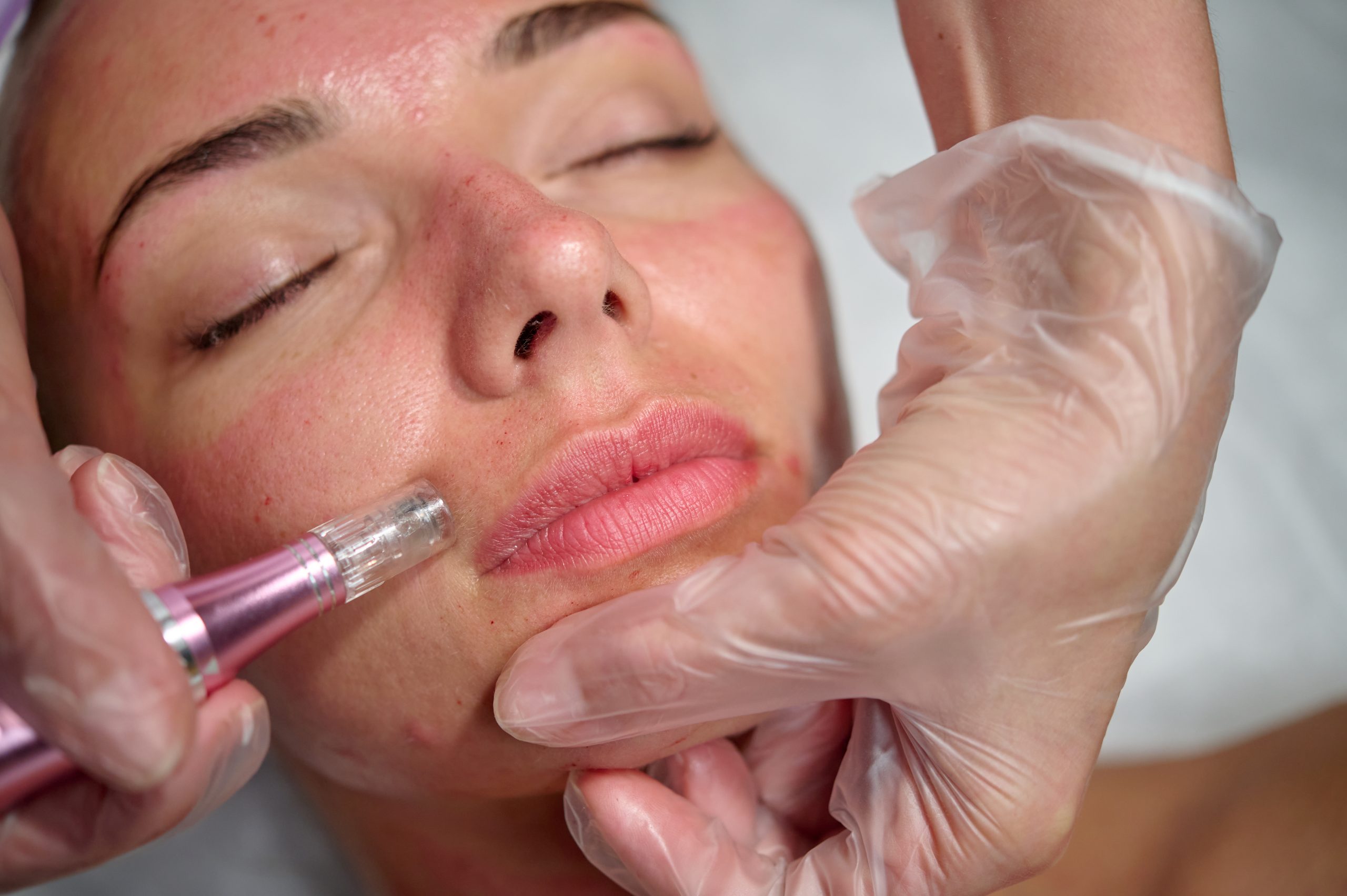 Cosmetician,Makes,Microneedling,,Care,To,The,Patient,Using,Dermapen