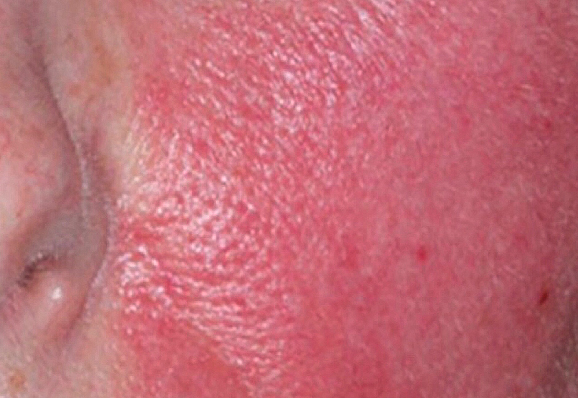 Rosacea-patient-2-photo-before- (1)